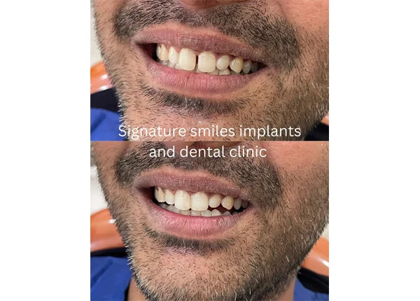 Before and After