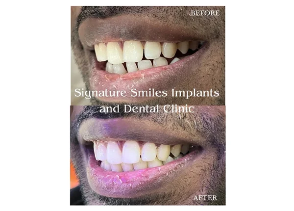 Before and After