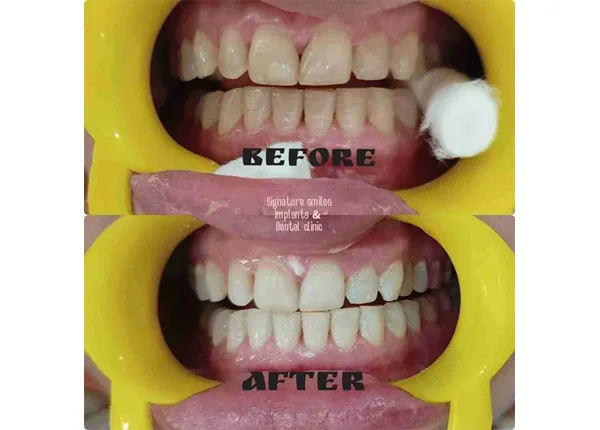 Before and After