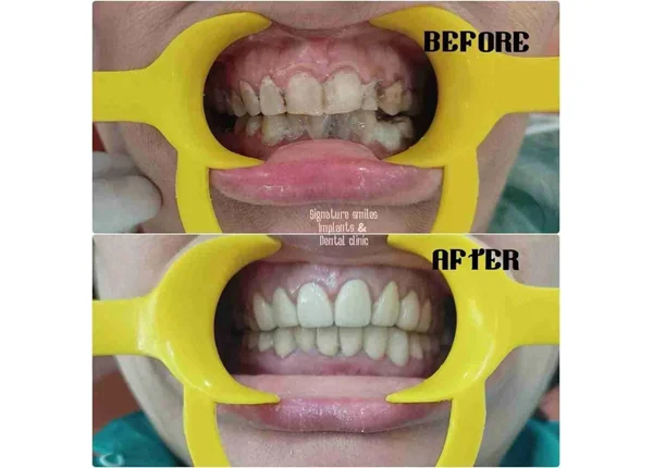 Before and After