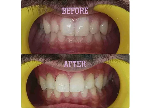 Before and After
