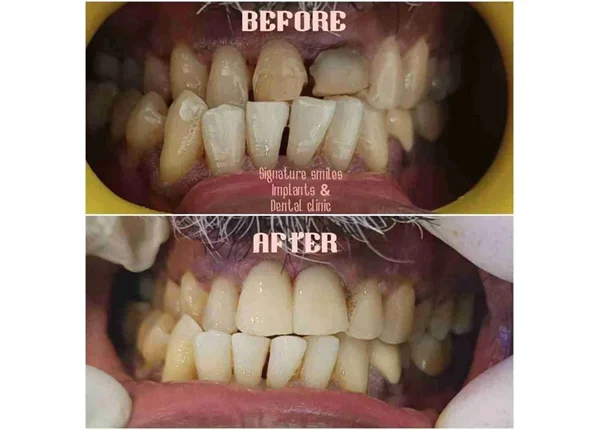 Before and After