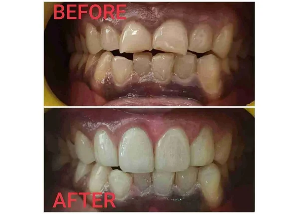 Before and After