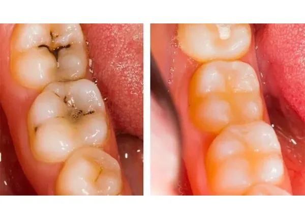 Before and After