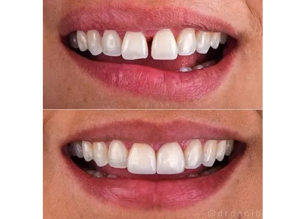 Before and After