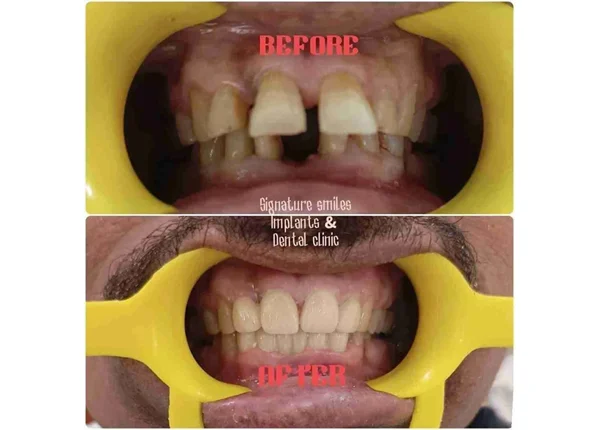 Before and After
