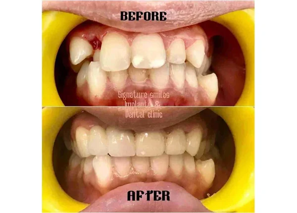 Before and After