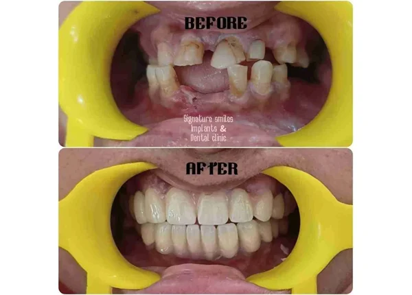 Before and After