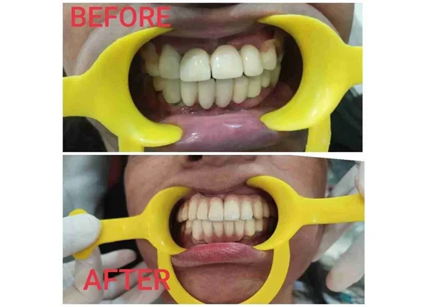 Before and After
