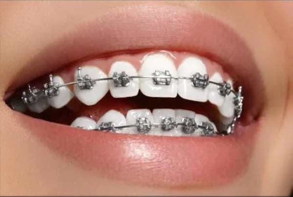 Braces and Orthodontic Treatment