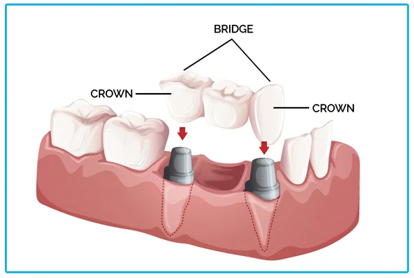 Tooth Cap and Crown Bridges