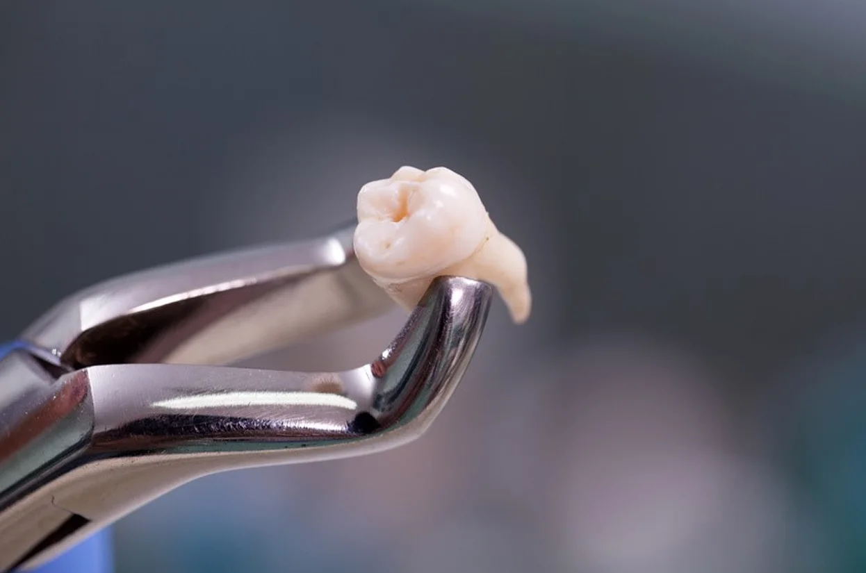 Wisdom Tooth Surgeries