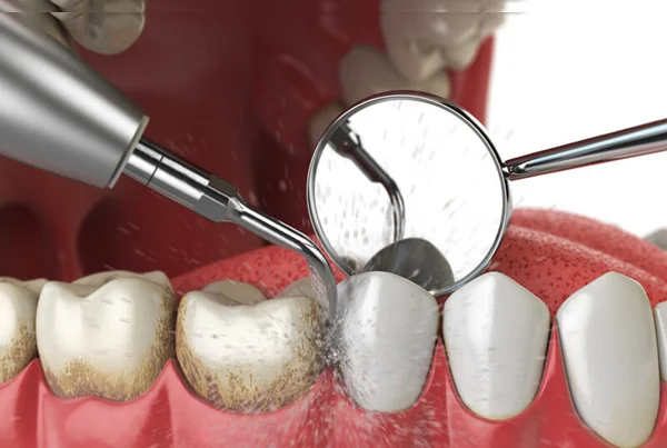 Scaling and Cleaning